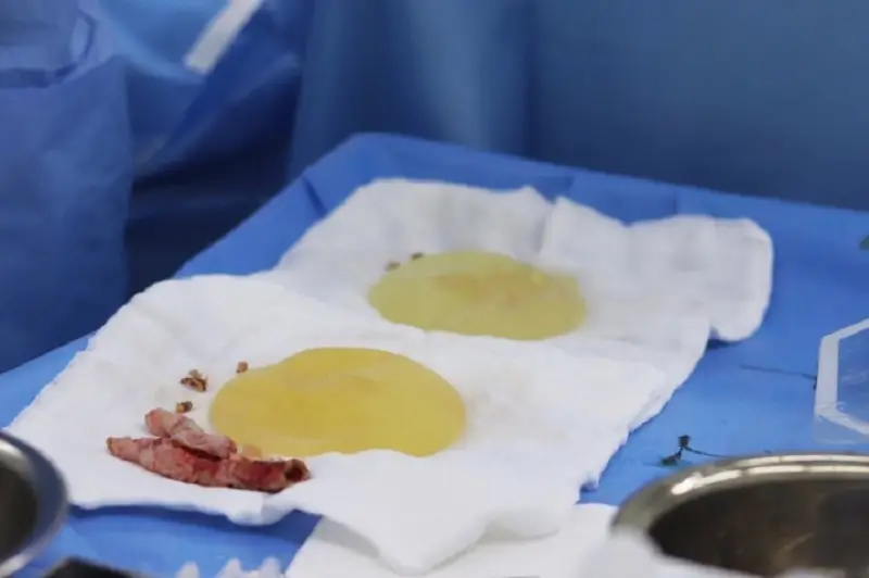 Túi ngực bị bao xơ sau khi được tháo ra khỏi vòng 1