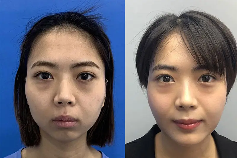 Cằm ngắn, lẹm nên cân nhắc trượt cằm