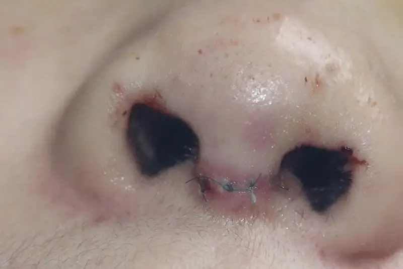 Ăn thịt gà có thể khiến vết thương vùng mũi chậm lành