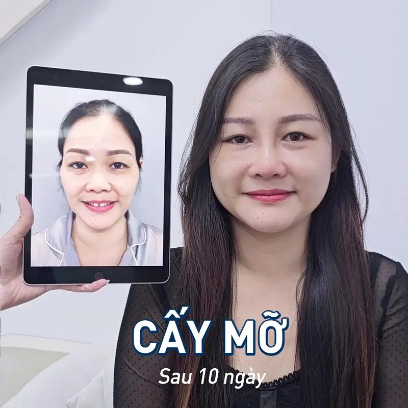 Khách hàng sở hữu khuôn mặt đầy đặn, căng tròn