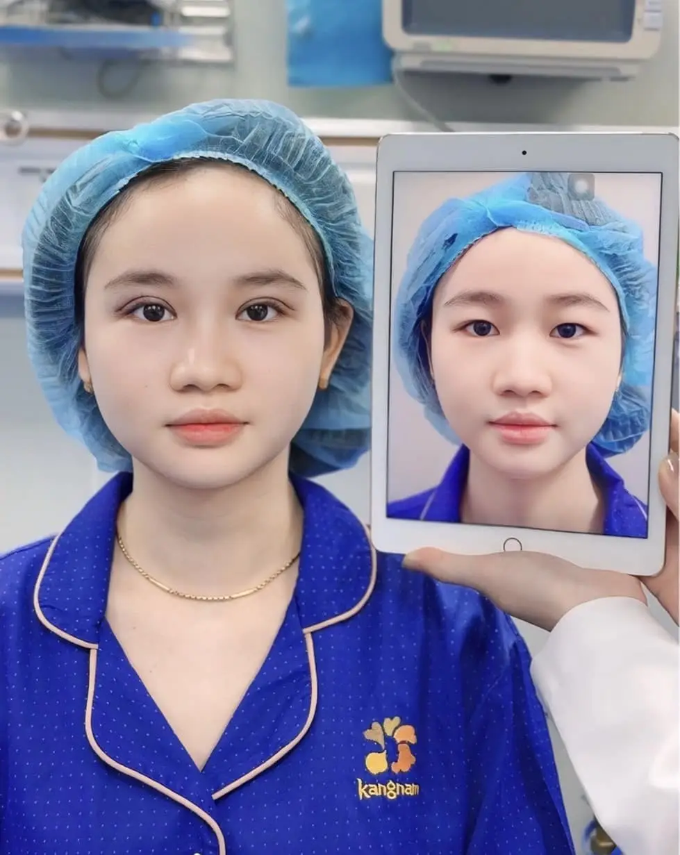 Cắt mí mắt giúp tạo nếp mí mới rõ rét, cân đối