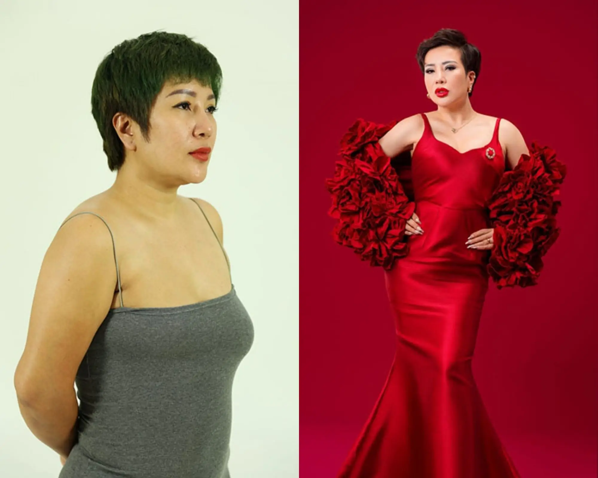 Khách hàng tái tạo ngực bởi TS. BS. Richard Huy