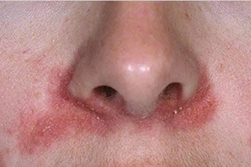 Mũi sưng đỏ, mẩn ngứa do phản ứng dị ứng sau khi ăn hải sản sau phẫu thuật