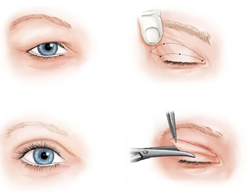 Phương pháp cắt mí thường không cần năm viện