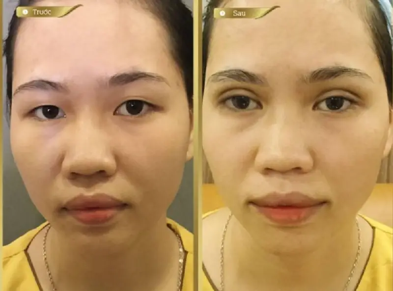 Cắt mí Open Deep khắc phục được khuyết điểm vùng mắt