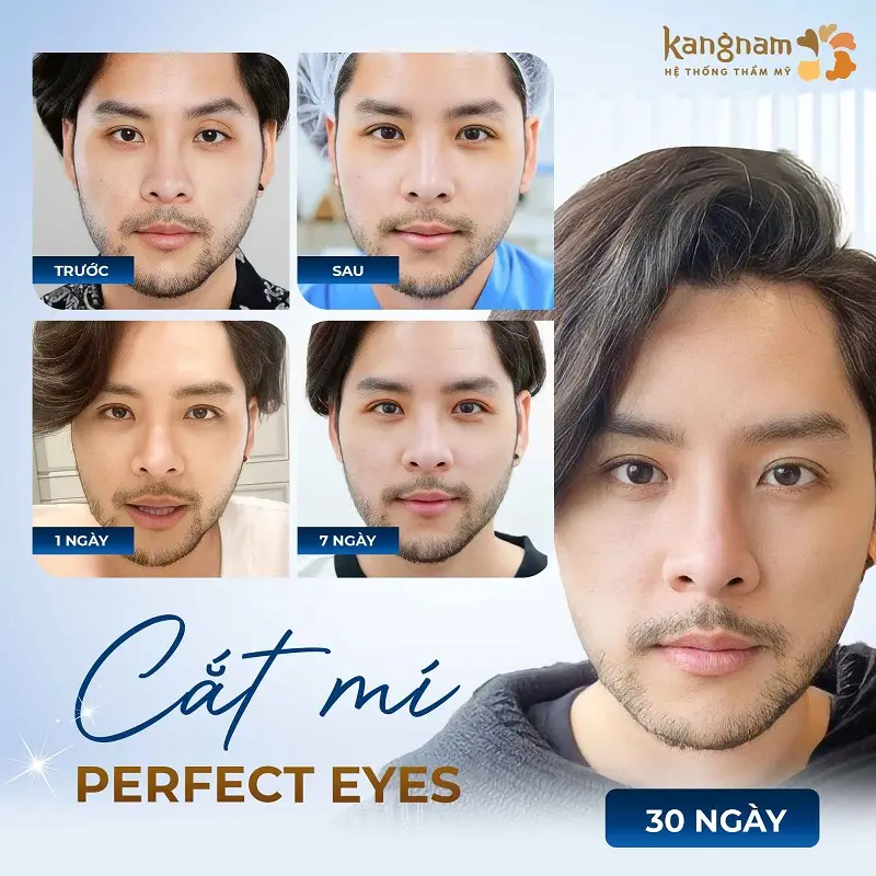 Cắt mí Perfect Eyes giúp khách hàng sở hữu đôi mắt đẹp tự nhiên, rút ngắn thời gian phục hồi