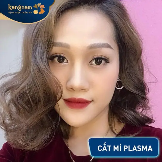 Cắt mí Plasma có giá dao động từ 7.000.000 - 10.000.000 VNĐ