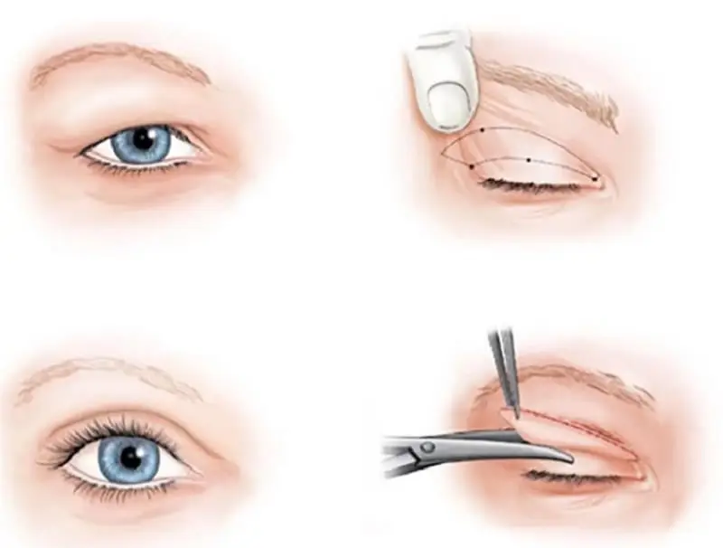 Cắt mí Plasma giữ được trên 10 năm