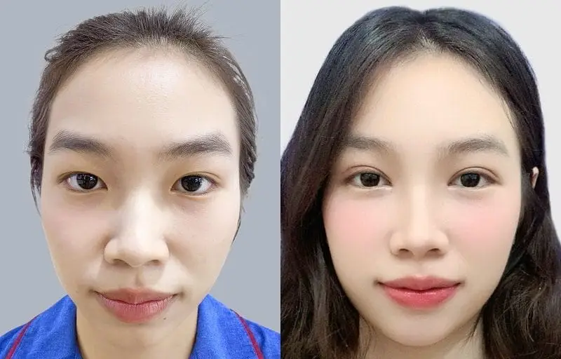 Cắt mí Plasma dùng dao mổ plasma tạo nếp mí đẹp tự nhiên