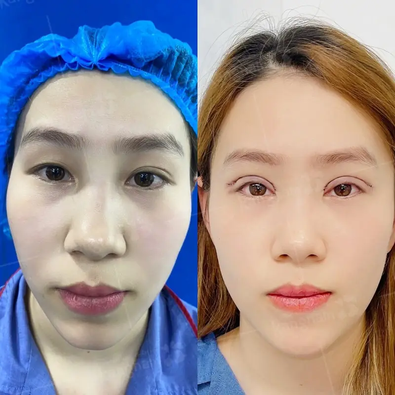 Kết quả cắt mí duy trì lâu dài