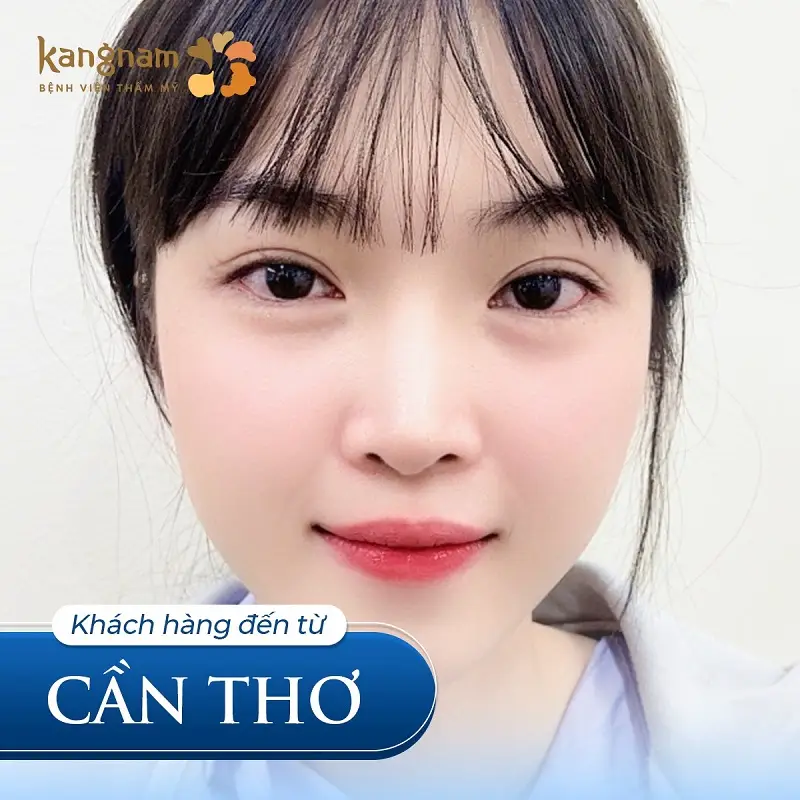 Cắt mí tại Kangnam có chi phí tương xứng với chất lượng dịch vụ