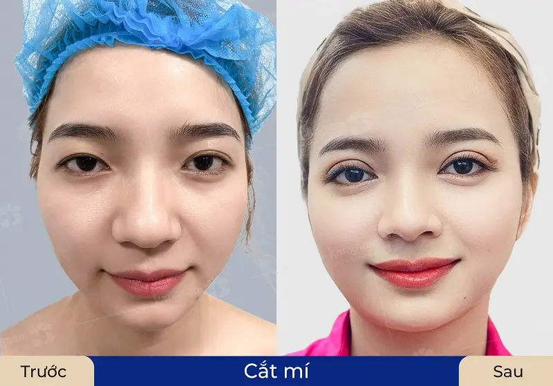 Khách hàng sau khi cắt mí tại Kangnam Cần Thơ sở hữu đôi mắt hai mí, cân đối với tổng thể khuôn mặt