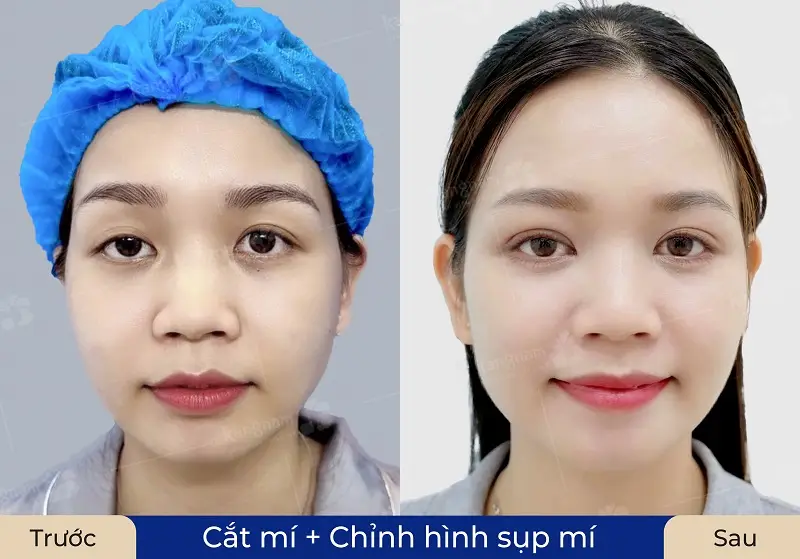 Cắt mí kết hợp chỉnh hình sụp mí giúp khách hàng sở hữu đôi mắt tự nhiên, cân đối