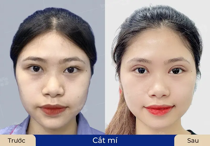 Sau cắt mí khách hàng khắc phục được khuyết điểm ở vùng mắt