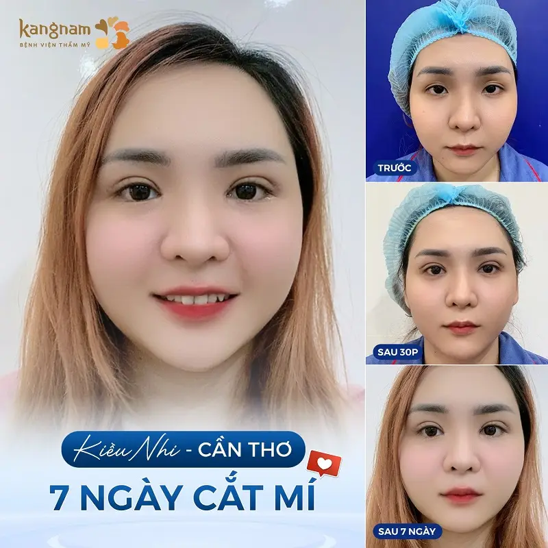 Dịch vụ cắt mí tại Kangnam Cần Thơ được đánh giá tốt và mang lại hiệu quả cao cho khách hàng