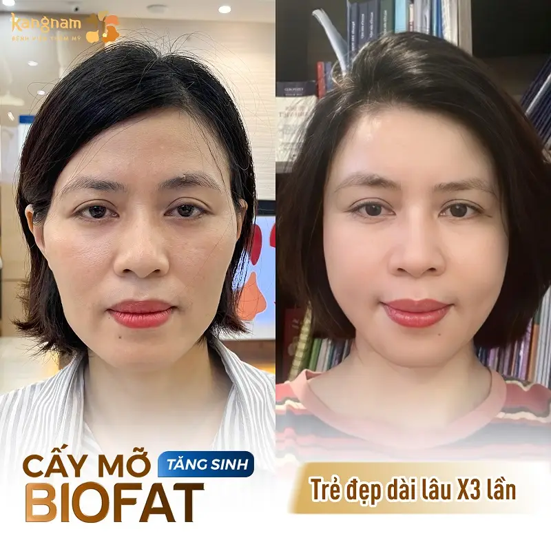 Cấy mỡ BioFat tăng sinh sử dụng mỡ tự thân được lấy từ cơ thể khách hàng, kết hợp với tế bào tăng sinh để duy trì hiệu quả lâu dài
