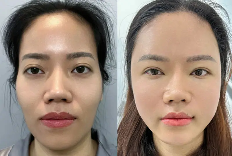 Khuôn mặt đầy đặn, tươi trẻ sau khi cấy mỡ tự thân