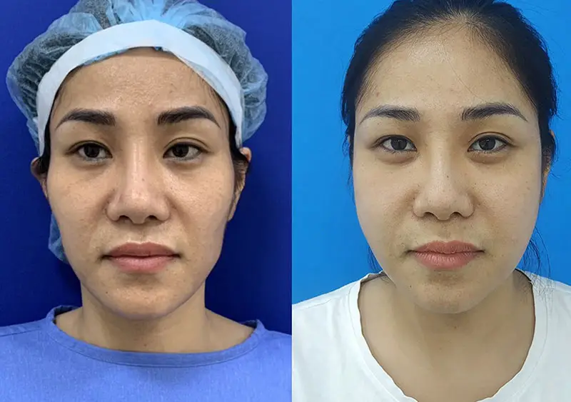 Cấy mỡ tự thân duy trì hiệu quả từ 2 - 3 năm