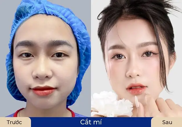 Chi phí cắt mí Hàn Quốc trên thị trường rất đa dạng