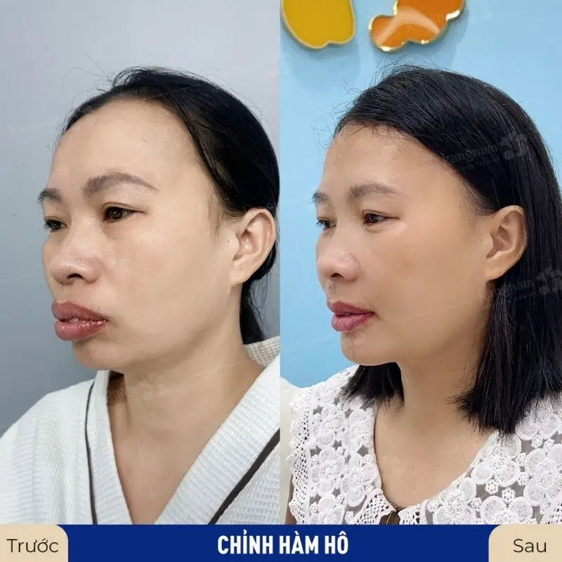 Khách hàng tại Kangnam chỉnh hàm hô, sở hữu gương mặt cân đối