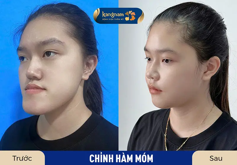 Chi phí phẫu thuật hàm móm khá cao