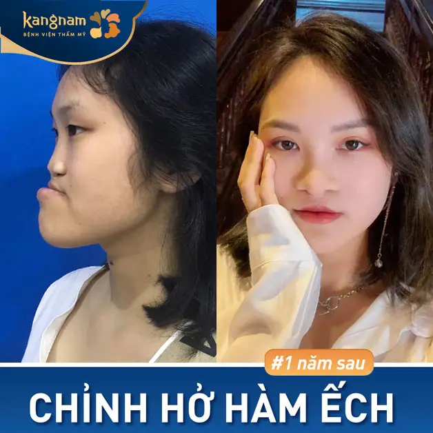 Khách hàng chỉnh hở hàm ếch tại Kangnam, thay đổi diện mạo ngoạn mục