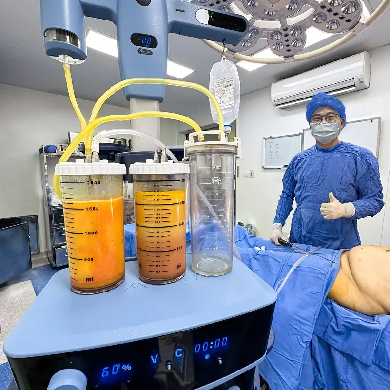 Bệnh viện Thẩm mỹ Kangnam ứng dụng công nghệ hút mỡ hiện đại