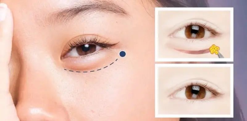 Mỗi cơ sở thẩm mỹ sẽ có giá cắt mí dưới khác nhau