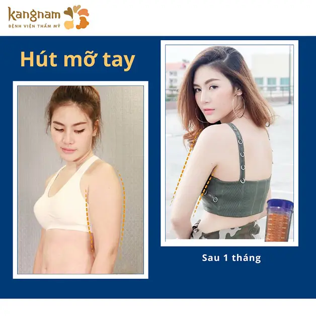 Giảm mỡ bắp tay có kết quả nhanh chóng, không cần ăn kiêng, tập luyện