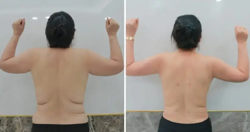 Hút mỡ bắp tay là giải pháp loại bỏ mỡ vùng cánh tay nhanh chóng