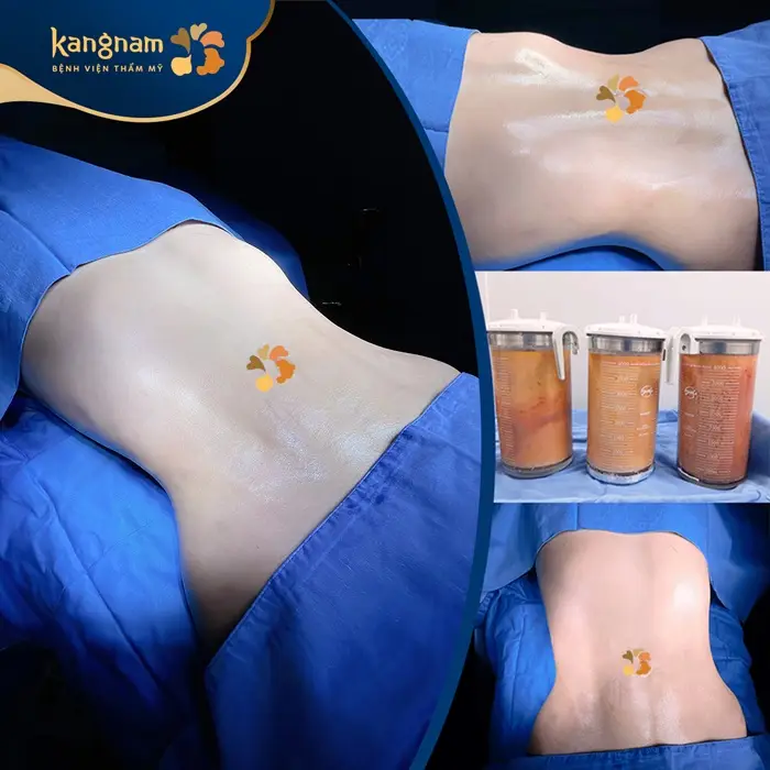 Khách hàng thực hiện hút mỡ bụng tại Kangnam
