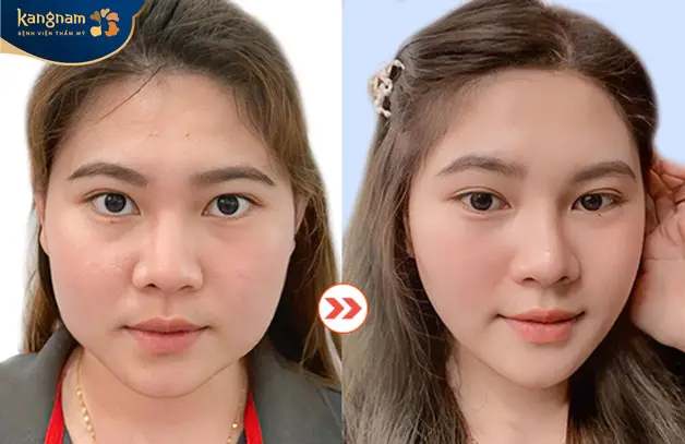 Gọt hàm tại Kangnam có chi phí phù hợp