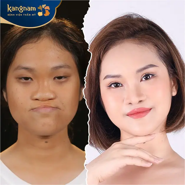 Phẫu thuật sửa môi