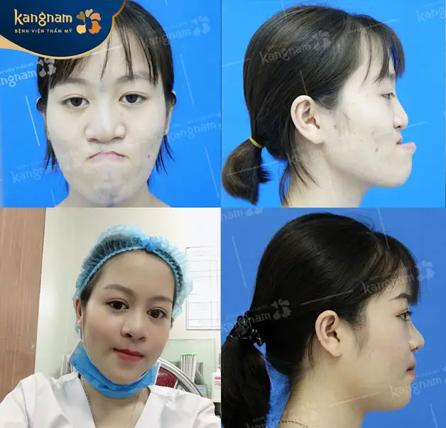 Kết quả trước và sau khi chỉnh hàm ếch