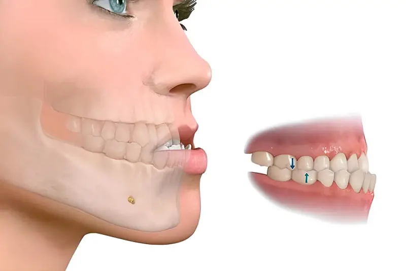 Hàm móm gây mất thẩm mỹ, ảnh hưởng chức năng ăn uống, nói chuyện