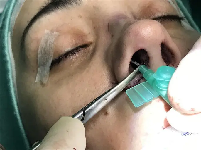 hút dịch ở mũi sau nâng mũi giúp cho vết thương nhanh lành và không bị nhiễm trùng và các biến chứng khác