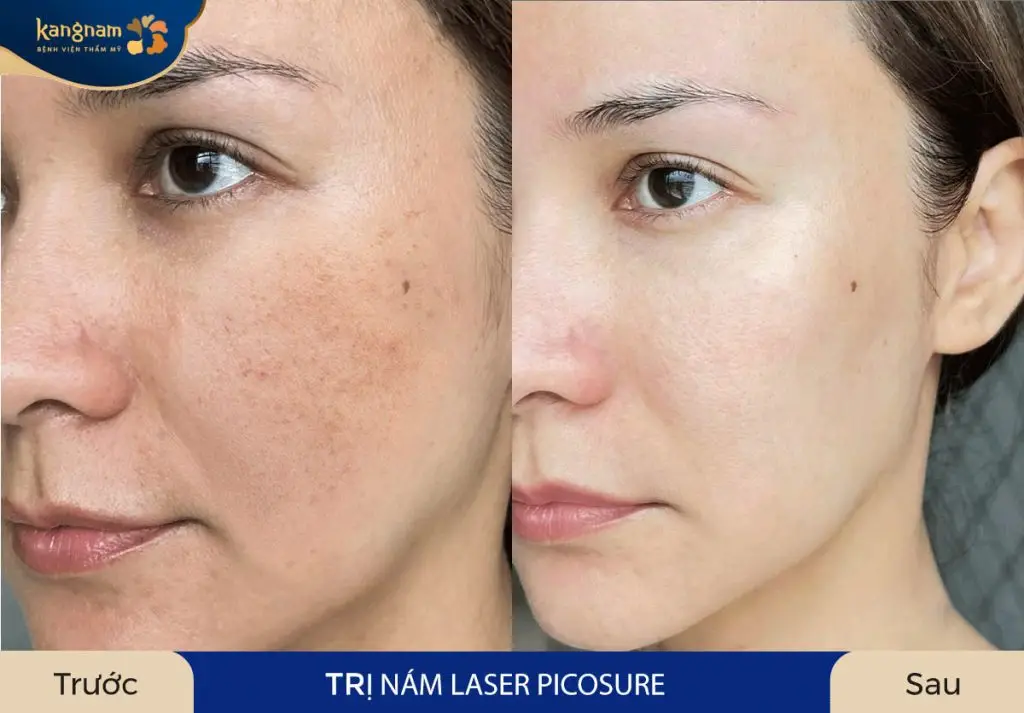 Công nghệ trị nám tàn nhang Laser Picosure Pro mang lại hiệu quả tối ưu