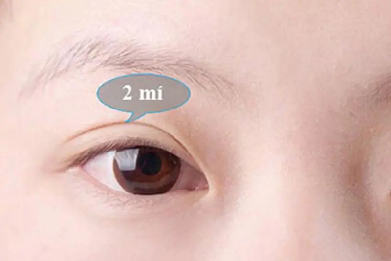 Mắt 2 mí có đường nếp mí rõ ràng