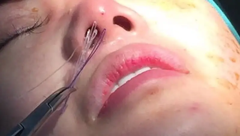 Mũi bị biến chứng sau khi nâng mũi bằng chỉ