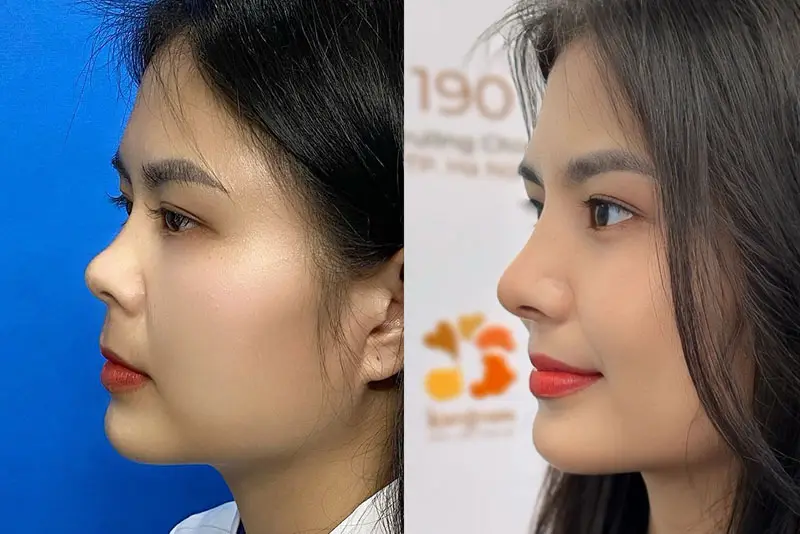 Khắc phục mọi khuyết điểm mũi