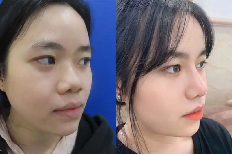 Nâng mũi sụn tự thân có chi phí dao động từ 30 - 100 triệu đồng