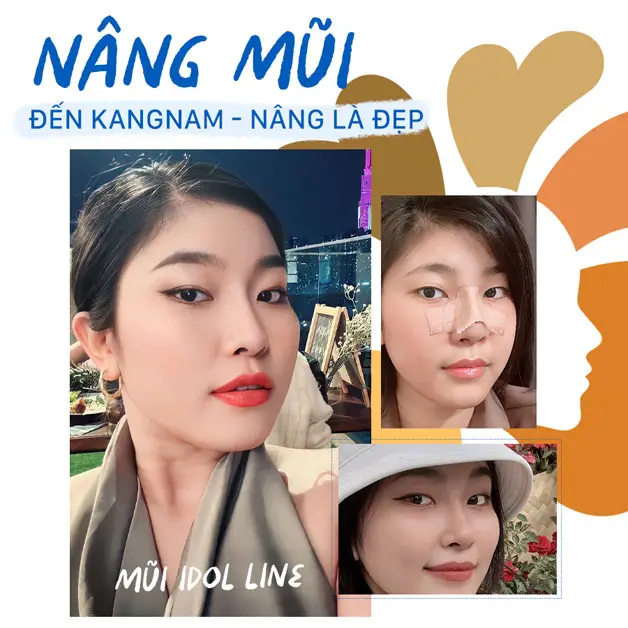 Xu hướng nâng mũi Idol Line