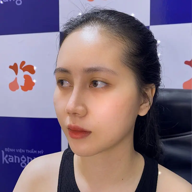 Dáng mũi L line cao tây