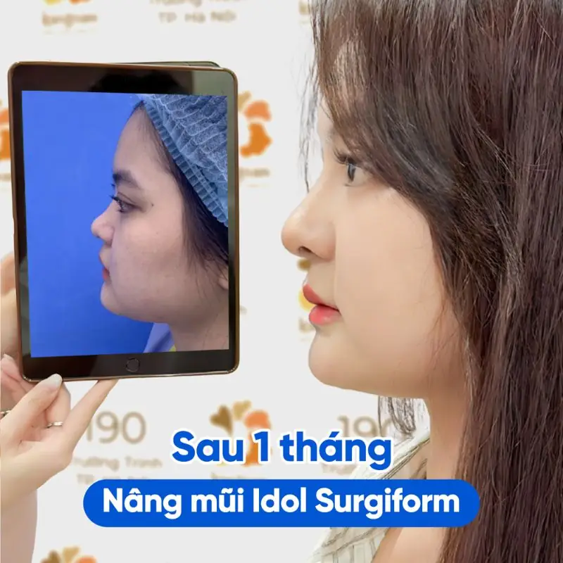 Nâng mũi 1 tháng đã ổn định và mềm mại hơn