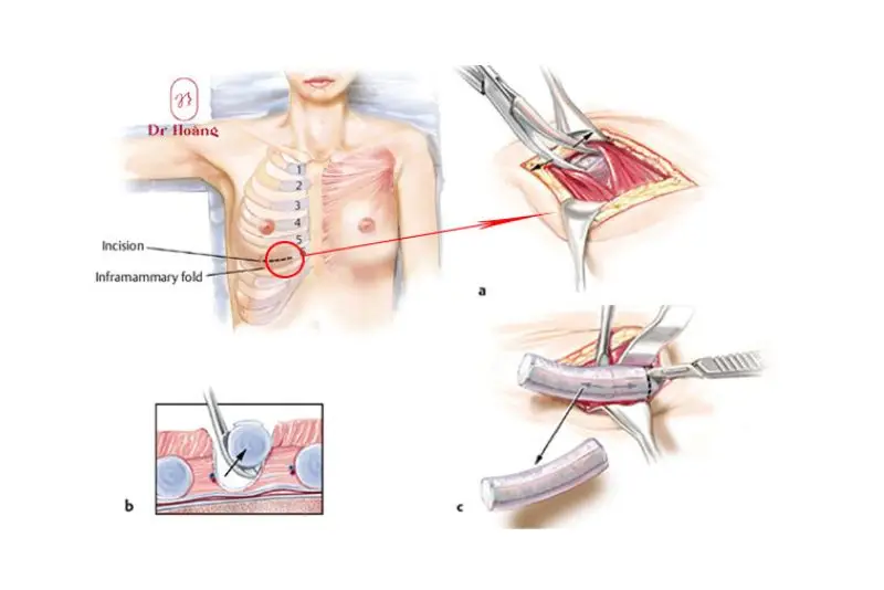 Quá trình lấy sụn sườn cần sự can thiệp chính xác