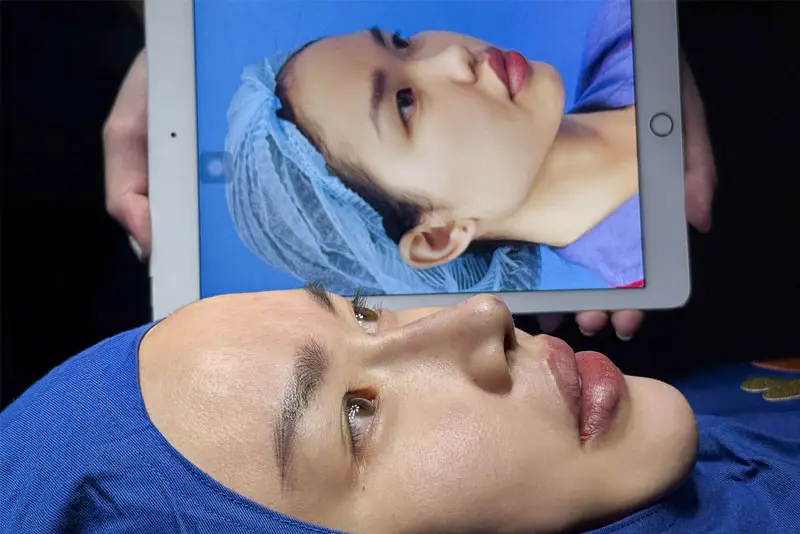 Nâng mũi chống chỉ định với người huyết áp cao, mắc bệnh tim mạch, tiểu đường...