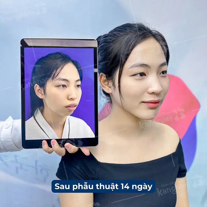 Chỉnh hàm hô giúp khuôn hàm cân đối, gương mặt thanh tú hơn