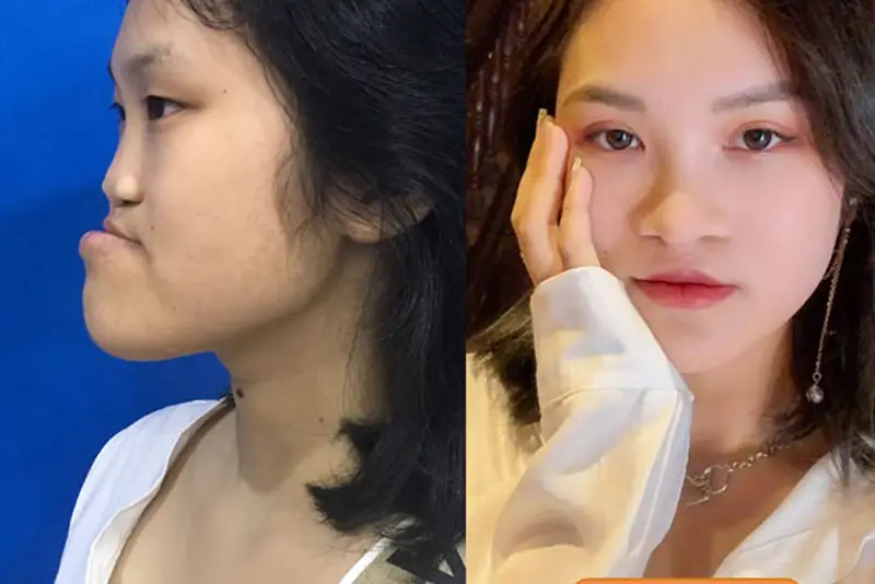 Phẫu thuật hở hàm ếch ở người lớn khá phá tạp