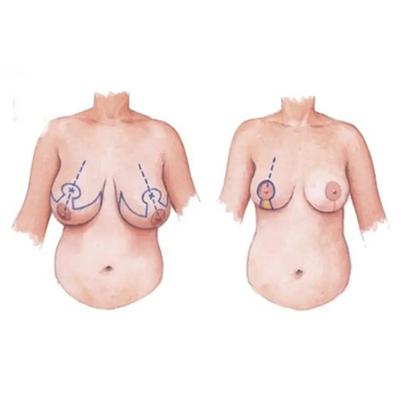 Treo sa trễ mất 2-3 tháng lành hoàn toàn