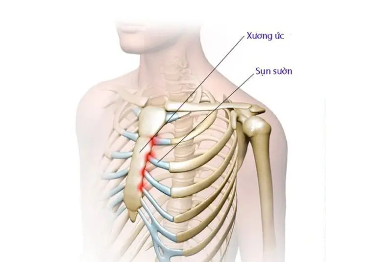 Sụn sườn là phần sụn nằm ở khu vực nối giữa xương sườn và xương ức